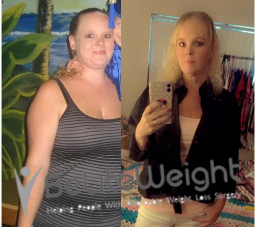 Weight Loss Surgery Gastric Sleeve before and after Dawn B - 1 Year Update*